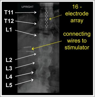 Epidural Spinal Cord Stimulation Acutely Modulates Lower Urinary Tract and Bowel Function Following Spinal Cord Injury: A Case Report